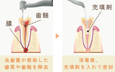 虫歯菌が感染した歯質や歯髄を除去し、消毒後充填剤を入れて密封