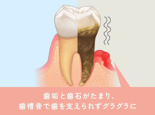 歯垢と歯石がたまり、歯槽骨で歯を支えられずグラグラに