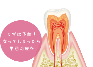 まずは予防！なってしまったら早期治療を