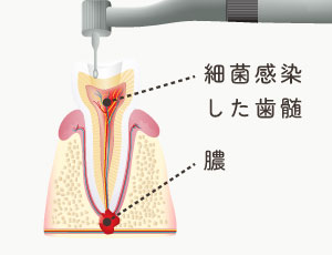 細菌感染した歯髄