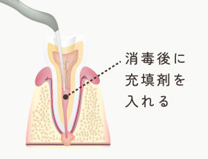 消毒後に充填剤を入れる