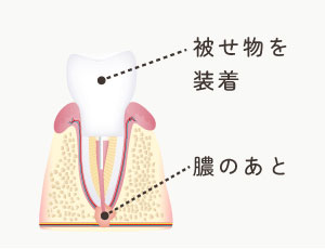 被せ物を装着